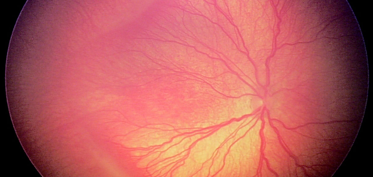 Retinopatia del prematuro